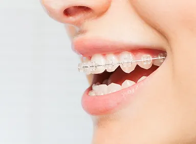 יישור שיניים עם גשר שקוף