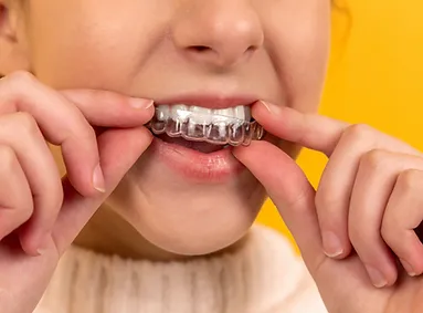 יישור שיניים שקוף ליישור אסתטי של השיניים
